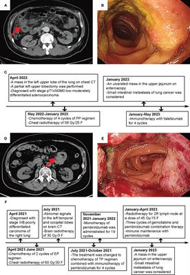 Case Report: Genetic profiling of small intestine metastasis from poorly differentiated non-small cell lung cancer: report of 2 cases and literature review of the past 5 years